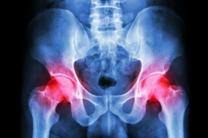 film x-ray human's pelvis and hip joints