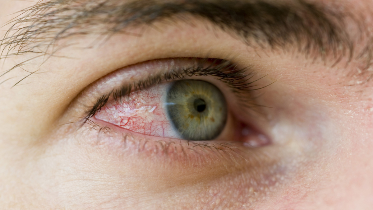 bloodshot eye